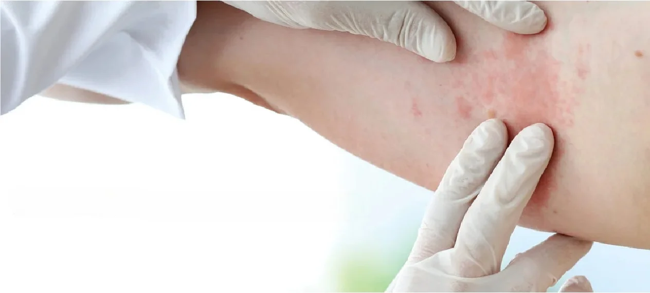 Know More About Melanoma And Skin Cancer Treatment